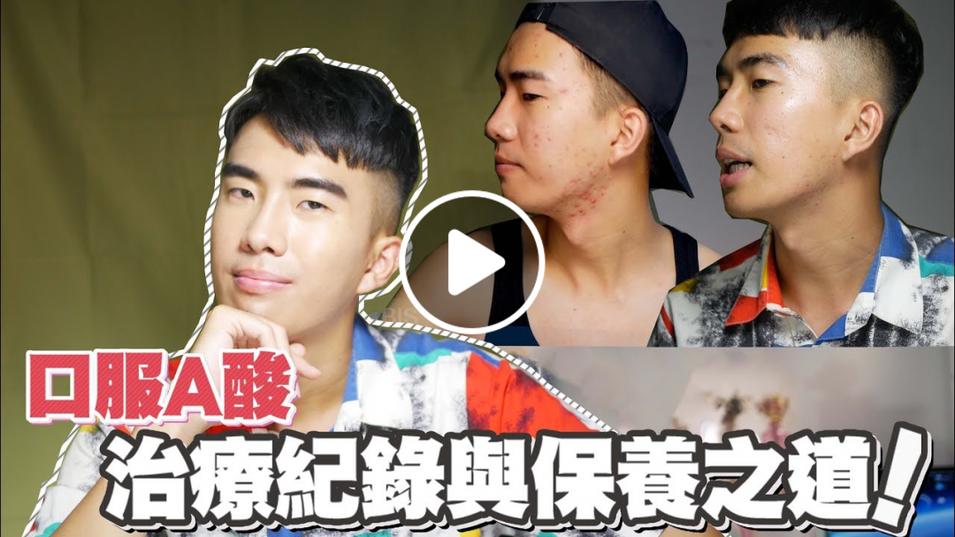 口服A酸3個月治療紀錄與保養分享，抗痘成功了？/MY ACCUTANE JOURNEY 3 MONTH UPDATE ｜ SHIN LI