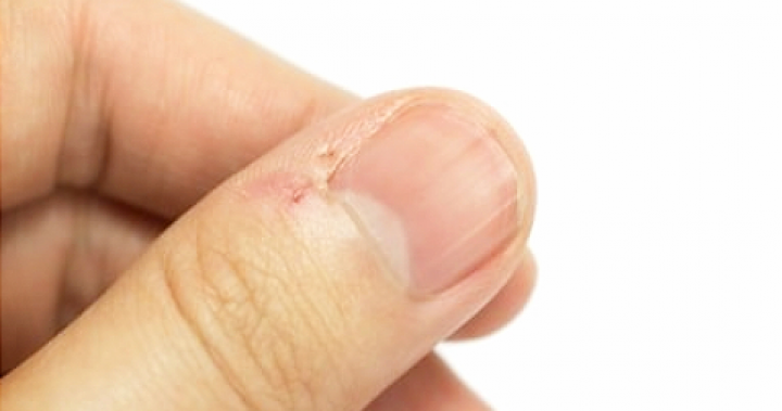 總是把指甲剪很短 小心發炎變凍甲 @ 創悅 皮膚 美學 :: 痞客邦 :: 總是把指甲剪很短 小心發炎變凍甲 @ 創悅 皮膚 美學 :: 痞客邦 ::