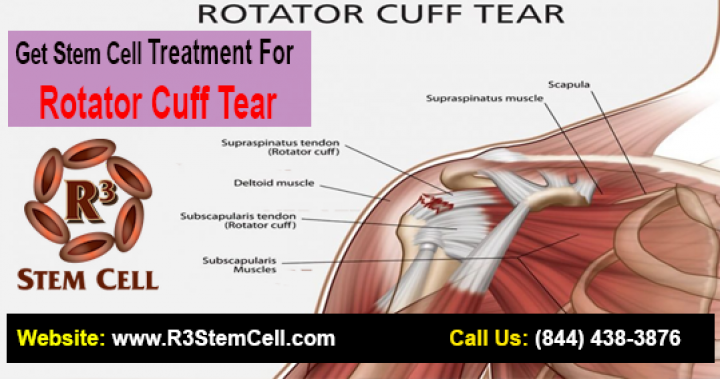 Treat Rotator Cuff Tear With Stem Cell Therapy